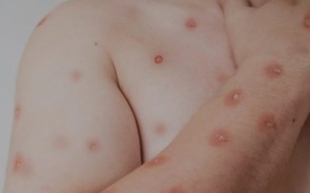Goiás investiga cinco casos suspeitos de Mpox; Goianésia está entre as cidades
