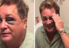 Leonardo sofre acidente durante pescaria e fica de olho roxo