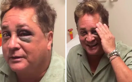 Leonardo sofre acidente durante pescaria e fica de olho roxo