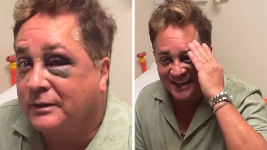Leonardo sofre acidente durante pescaria e fica de olho roxo